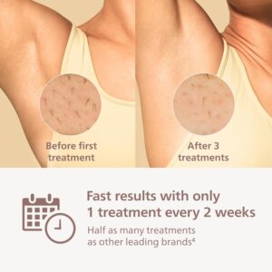 Philips Lumea 8000 Series IPL Review